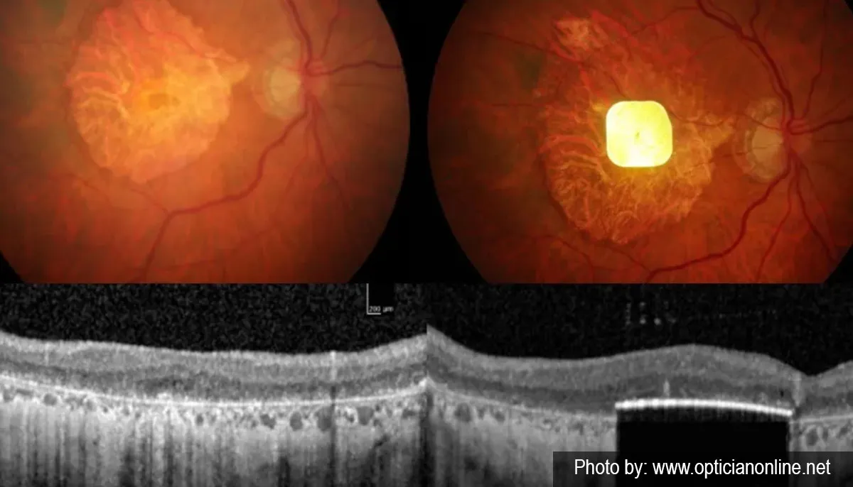انقلاب ایمپلنت چشمی بینایی بیماران amd خشک بازیابی شد